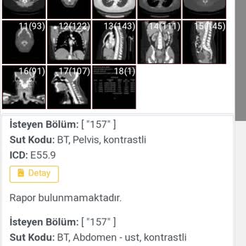 İzmir Bayraklı Şehir Hastanesi Şehir Hastanesinde Çekilen Bt 25 Oldu Sonuç Hala Yok