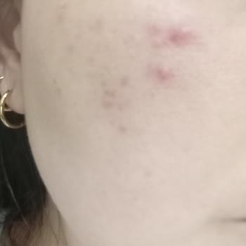 Cildimi Mahvetti Cream Co