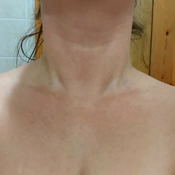 Loreal Paris Yüz Kremi Alerjisi