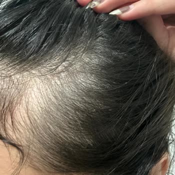 Urban Care Aşırı Saçımı Döktü