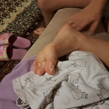 Adidas Ayakkabı Ayak Derisi Nin Atması Renk Vermesi
