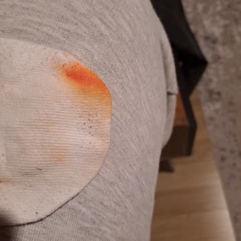 Adidas Ayakkabı Ayak Derisi Nin Atması Renk Vermesi