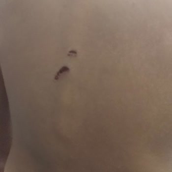 Gülveren Anaokulu Yeşilova'da Çocuğumun Sırtında Tırnak İzi Var!