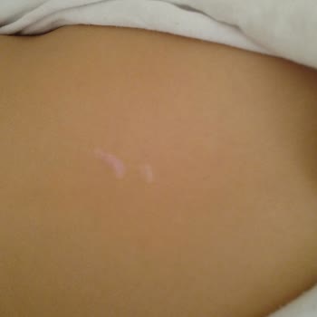 Gülveren Anaokulu Yeşilova'da Çocuğumun Sırtında Tırnak İzi Var!