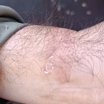 Huawei Watch Fit 2 Kolumda Alerjik Reaksiyona Sebep Oldu