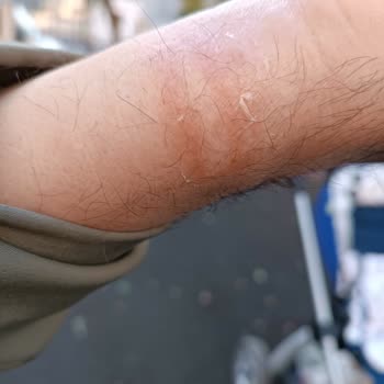 Huawei Watch Fit 2 Kolumda Alerjik Reaksiyona Sebep Oldu