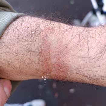 Huawei Watch Fit 2 Kolumda Alerjik Reaksiyona Sebep Oldu