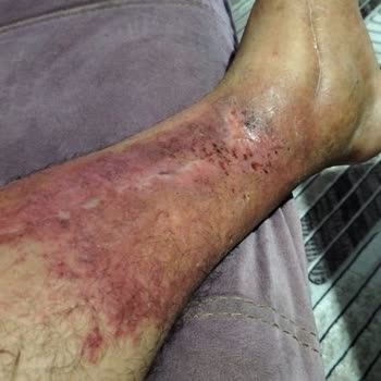 Turgutlu Devlet Hastanesi Babamın Yaşadığı Tıbbi İhmal