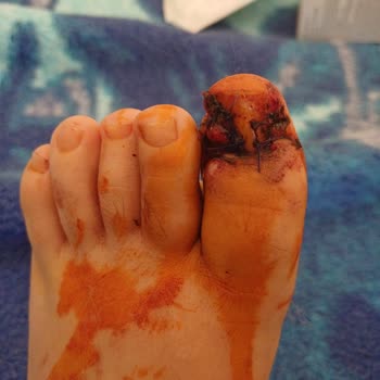 Gaziantep 25 Aralık Devlet Hastanesi Ameliyat Sonrası Bilgi Vermek Yok Sıfır Bilgi Doktor Ve Hemşire