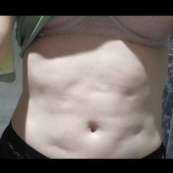 Op. Dr. Ferruh Bingül Liposuction Sonrası Dalgalanma Çukurlar