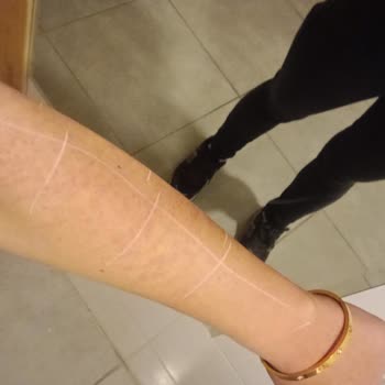 E-life Estetik & Güzellik E-LİFE Lazer Yanık❌❌❌