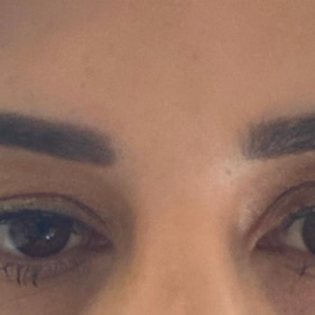 British Esthetic British Estetik Botox Sonrası Gözümden Oluyordum