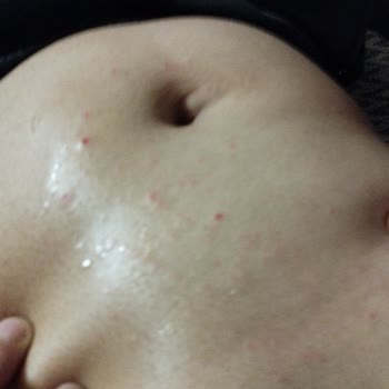 Bioder Krem Cildimi Yaktı