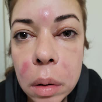 Betül Yıldız Güzellik Merkezi Yüze Dolgu Yapması İle Yüzüm Mahvoldu.