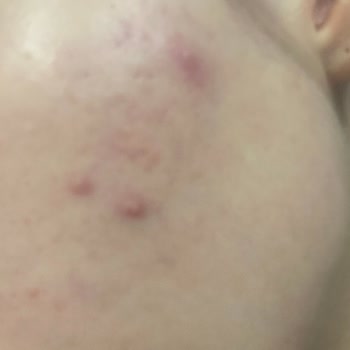 Bioderma Sensibio Yüz Yıkama Jeli Sivilce Yaptı