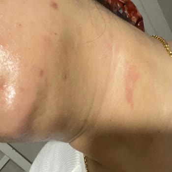 Yves Rocher Yağlı Ciltler İçin Aldığım Yüz Yıkama Jeli Şişti Ve Kızarttı