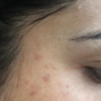 Abel Estetik Güzellik Yüzüm Yara İçinde Kaldı