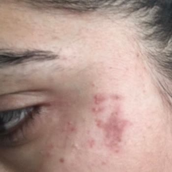 Abel Estetik Güzellik Yüzüm Yara İçinde Kaldı