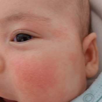 İstanbul Alerji Merkezi Tedavi Süreci!