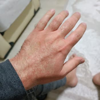 Peros Çamaşır Deterjanı İle Oluşan Alerji