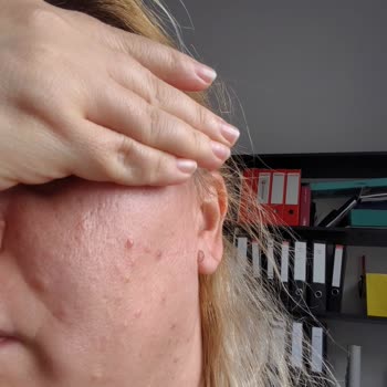 Avéne Cilt Bakım Kremi Alerji Yaptı!