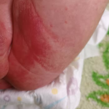 Nestlé İyi Büyüsün İyi Yaşasın Ama Mama Alerji Ve Pişik