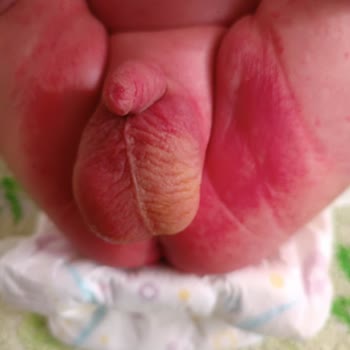 Nestlé İyi Büyüsün İyi Yaşasın Ama Mama Alerji Ve Pişik