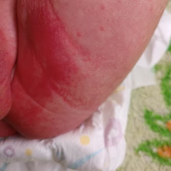 Nestlé İyi Büyüsün İyi Yaşasın Ama Mama Alerji Ve Pişik