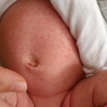 Nestlé İyi Büyüsün İyi Yaşasın Ama Mama Alerji Ve Pişik