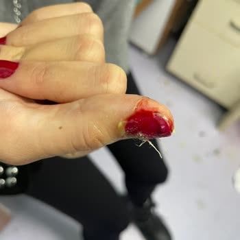 Tırnağım Koptu Migros Dolabı Yüzünden