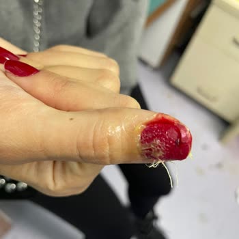 Tırnağım Koptu Migros Dolabı Yüzünden