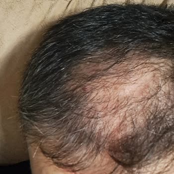 Medicana Hospitals Saç Ektirdiğime Bin Pişmanım:(