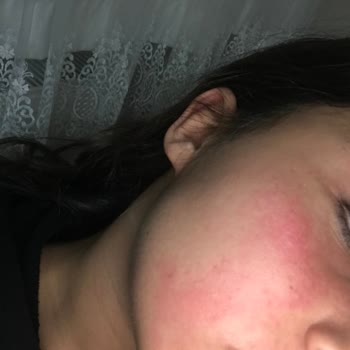 Elidor Alerji Ve Şişme