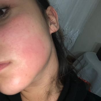 Elidor Alerji Ve Şişme