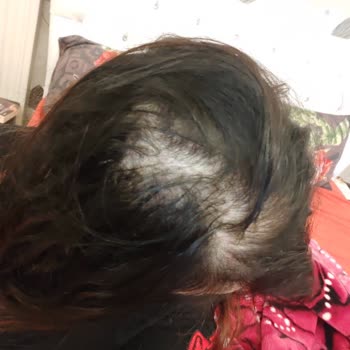 Sedat Biga Hair Studio İstanbul'da Yapılan Kaynak Saç Uygulamasından Yaşanan Memnuniyetsizlik