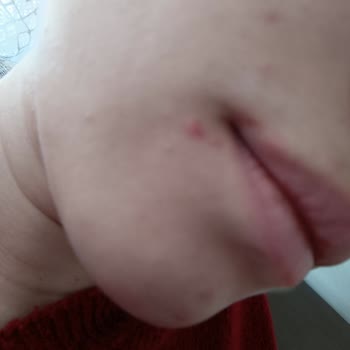 Note Cosmetics Note Cosmetik Sivilce Ve Komedon Yaptı