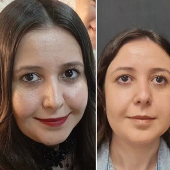 Yaman Cerrahi Tıp Merkezi  Bisektomi Hiçbir İşe Yaramadı