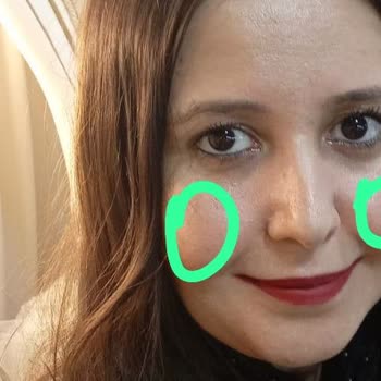 Yaman Cerrahi Tıp Merkezi  Bisektomi Hiçbir İşe Yaramadı