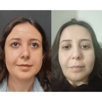 Yaman Cerrahi Tıp Merkezi  Bisektomi Hiçbir İşe Yaramadı