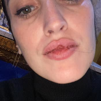 Sağlık Bakanlığı Yeniköy Kliniği'nde Dudak Dolgusu Sorunları