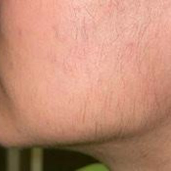 Feliz Spa & Beautyland Lazerde Kil Artışı