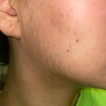 Feliz Spa & Beautyland Lazerde Kil Artışı