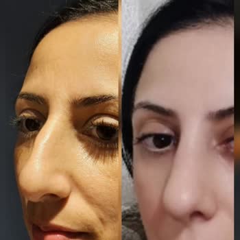 Medicana Çamlıca Hastanesi Burun Estetiği Şikayeti