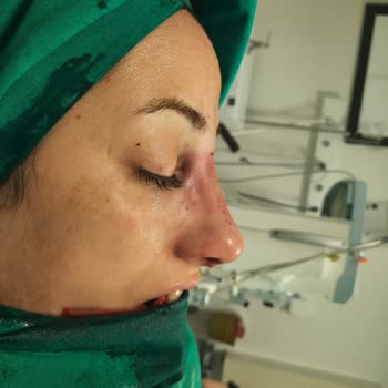 Medicana Çamlıca Hastanesi Burun Estetiği Şikayeti