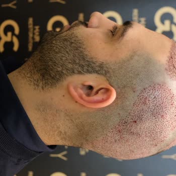 Gold City Hair İstanbul 11 Ayın Sonundaki Pişmanlık