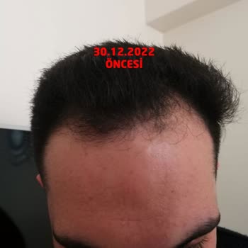 Gold City Hair İstanbul 11 Ayın Sonundaki Pişmanlık