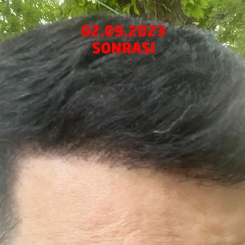 Gold City Hair İstanbul 11 Ayın Sonundaki Pişmanlık