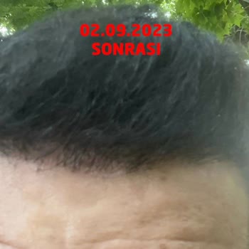 Gold City Hair İstanbul 11 Ayın Sonundaki Pişmanlık