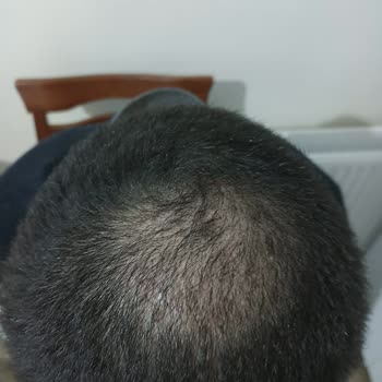 Gold City Hair İstanbul 11 Ayın Sonundaki Pişmanlık