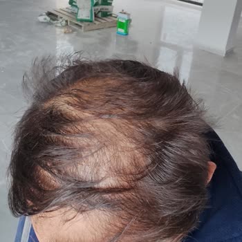 Üsküdar HospitalTürk Saç Ekimi Yaptırmayın